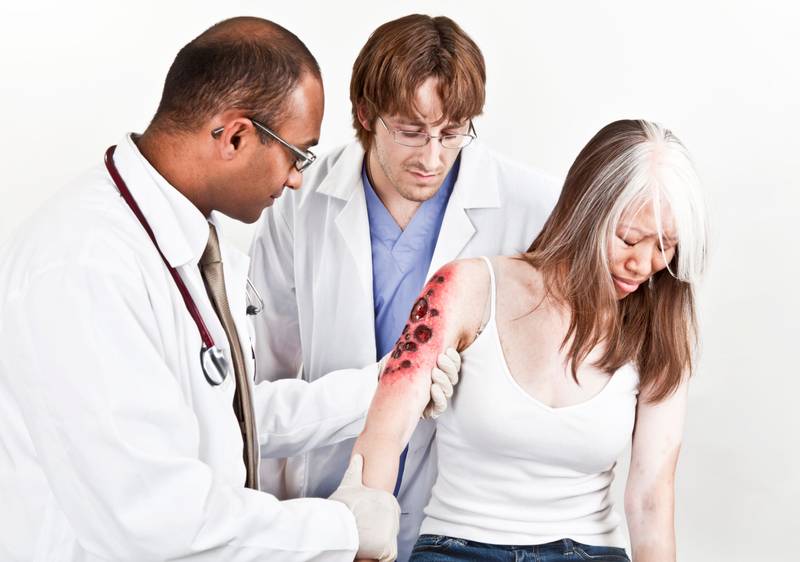 Catastrophic burn injury lawyer in San Diego and Virginia Beach - Mackie Injury Lawyers
